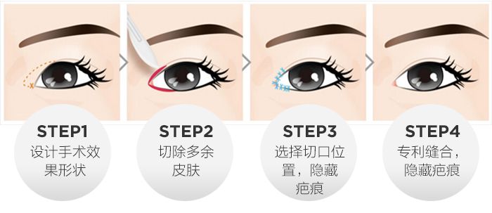 開內(nèi)眼角方法